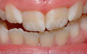 Эрозия зубов и причины ее возникновения